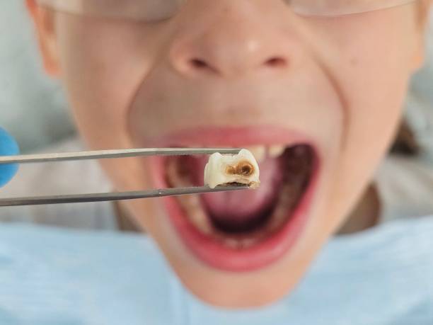 Best Knocked-Out Tooth (Avulsed Tooth) Treatment in La Center, WA